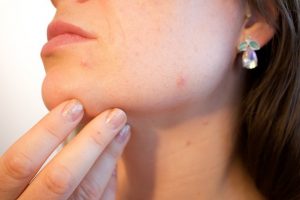 flea bites